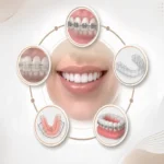 Types of Orthodontics 150x150