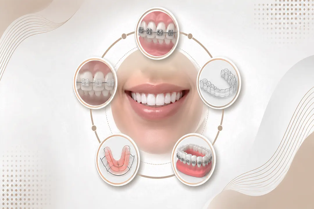 Types of Orthodontics