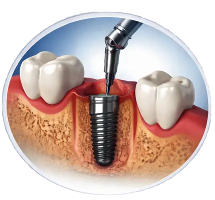 Implant 1