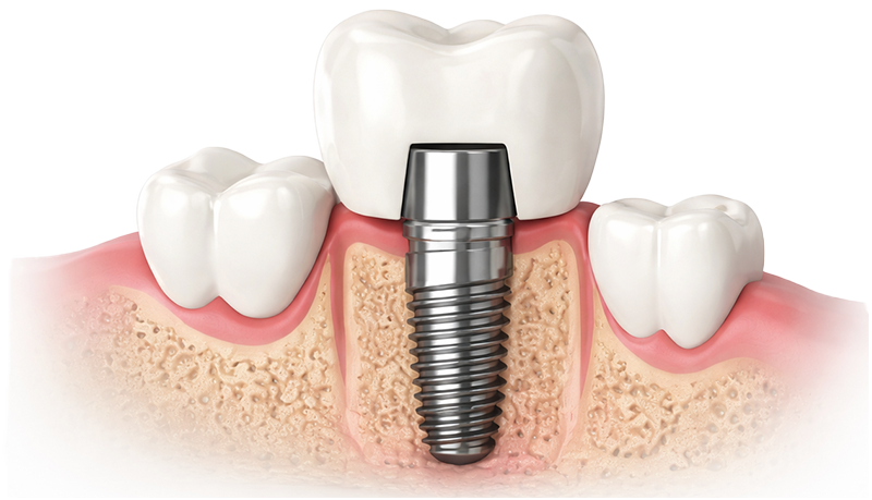 Implant2