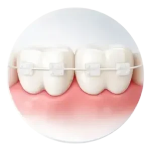 Ceramic braces 300x300