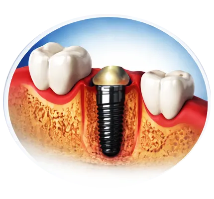Implant 22