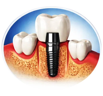 Implant 3