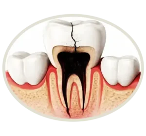 Nakroz teeth 300x279