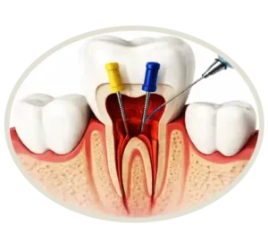 Retreatment teeth 300x279