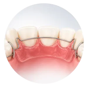 Lingual braces2 300x300