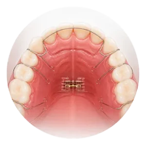 ارتودنسی 3 Removable Braces3 300x300