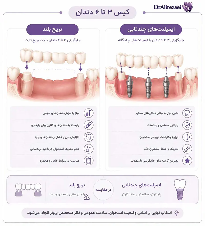 Implant bridge3 6