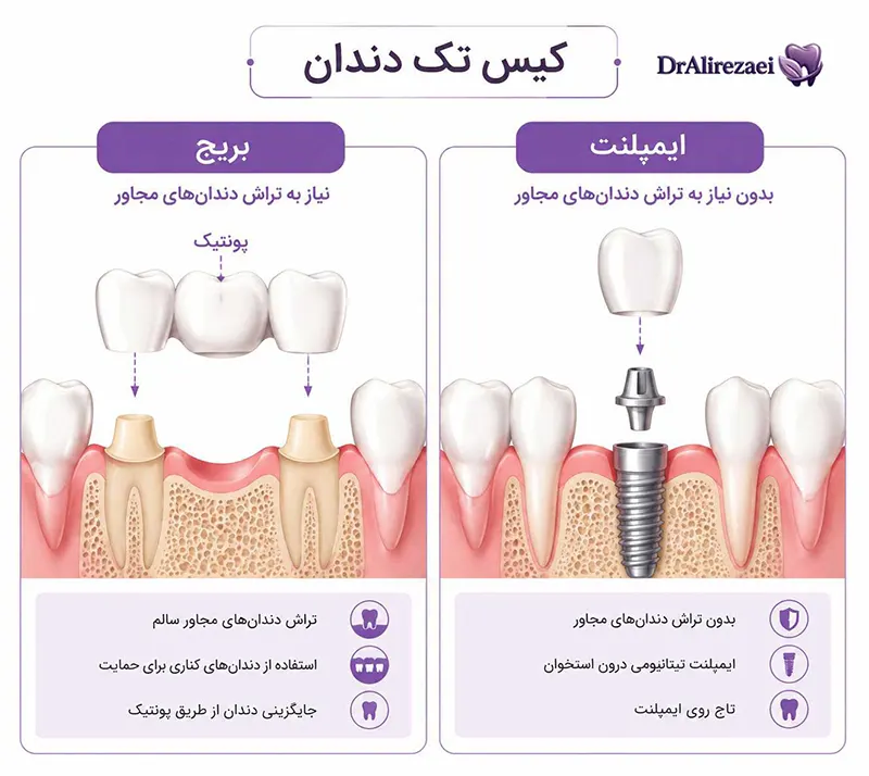 Implant or bridg 1