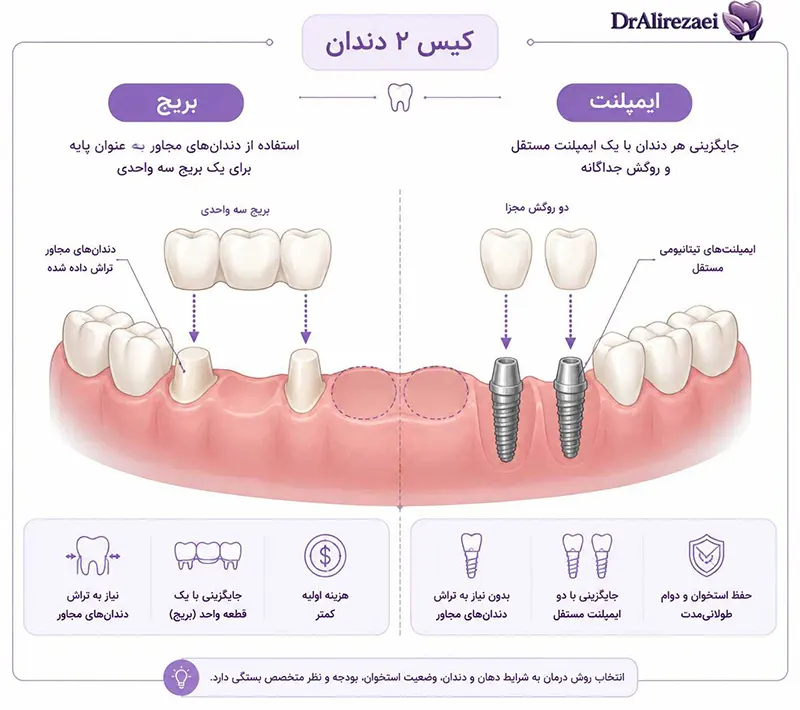 Implant or bridge 2