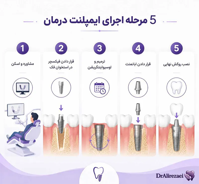 Implant steps