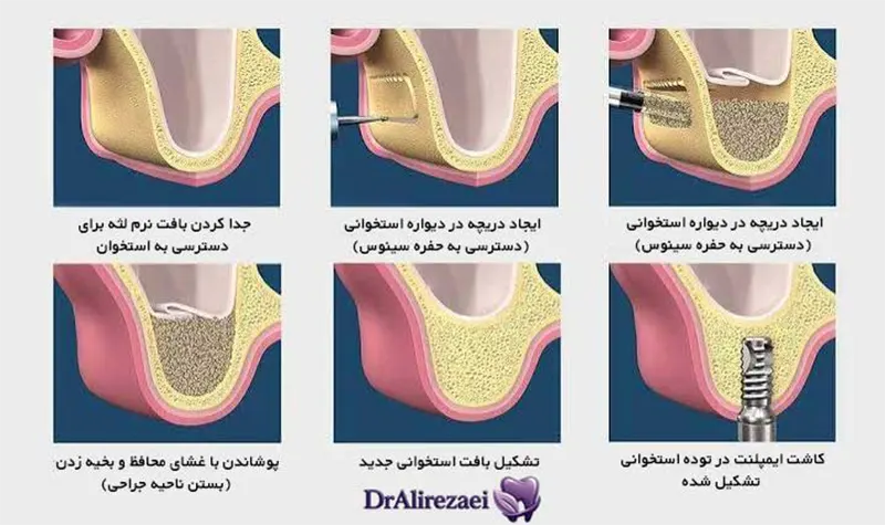 Lateral Sinus Augmentation