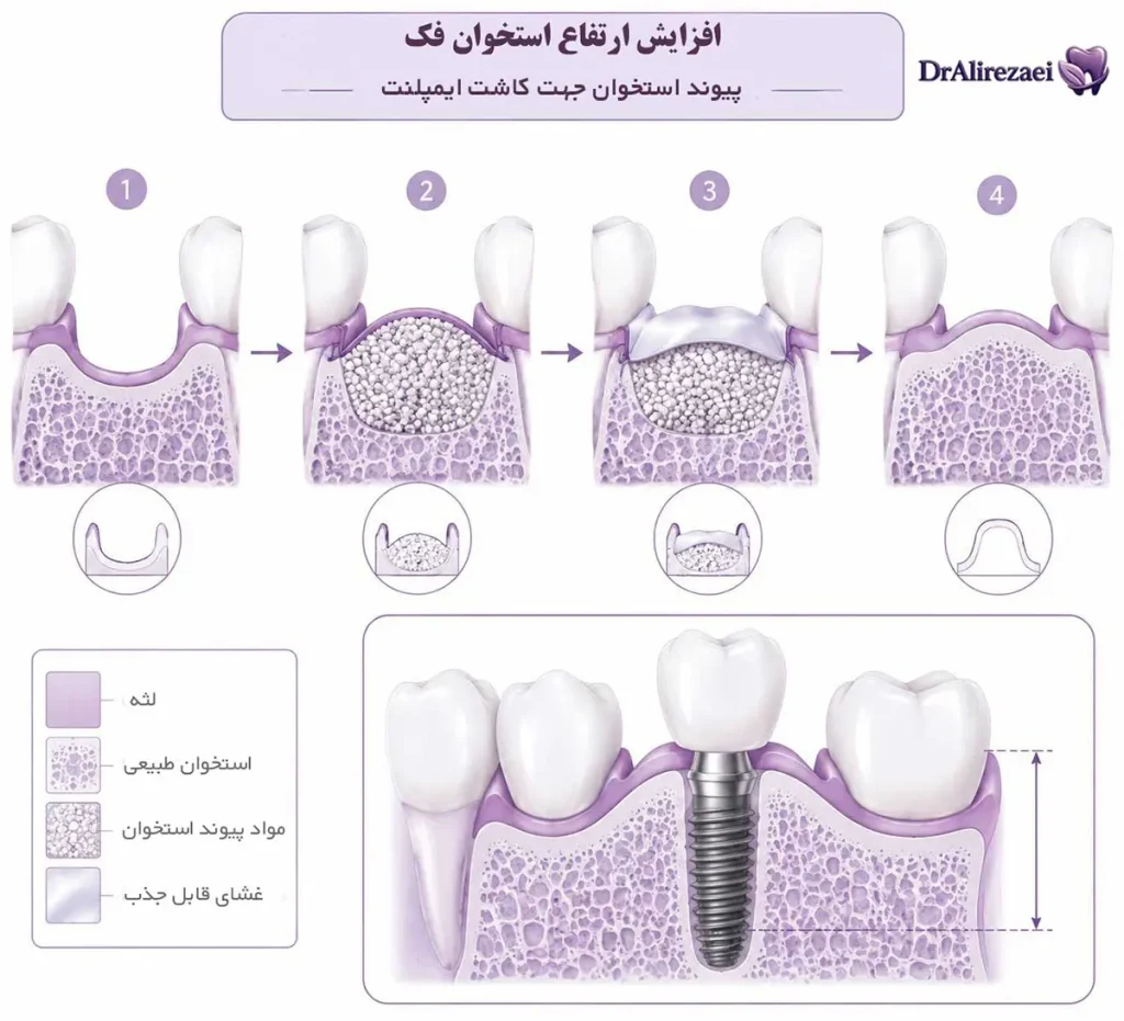 Vertical Ridge Augmentation 1024x931
