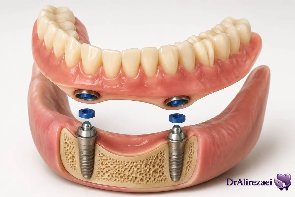 Overdenture